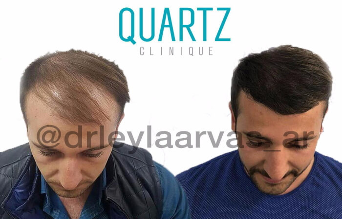 زراعة الشعر