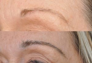 عملية تجميل الحواجب في تركيا