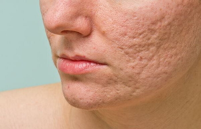 طرق علاج الندبات العميقة في الوجه