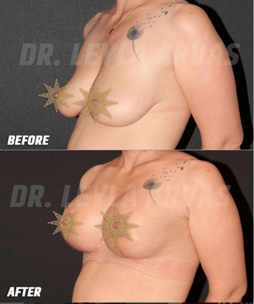 عملية تجميل الثدي