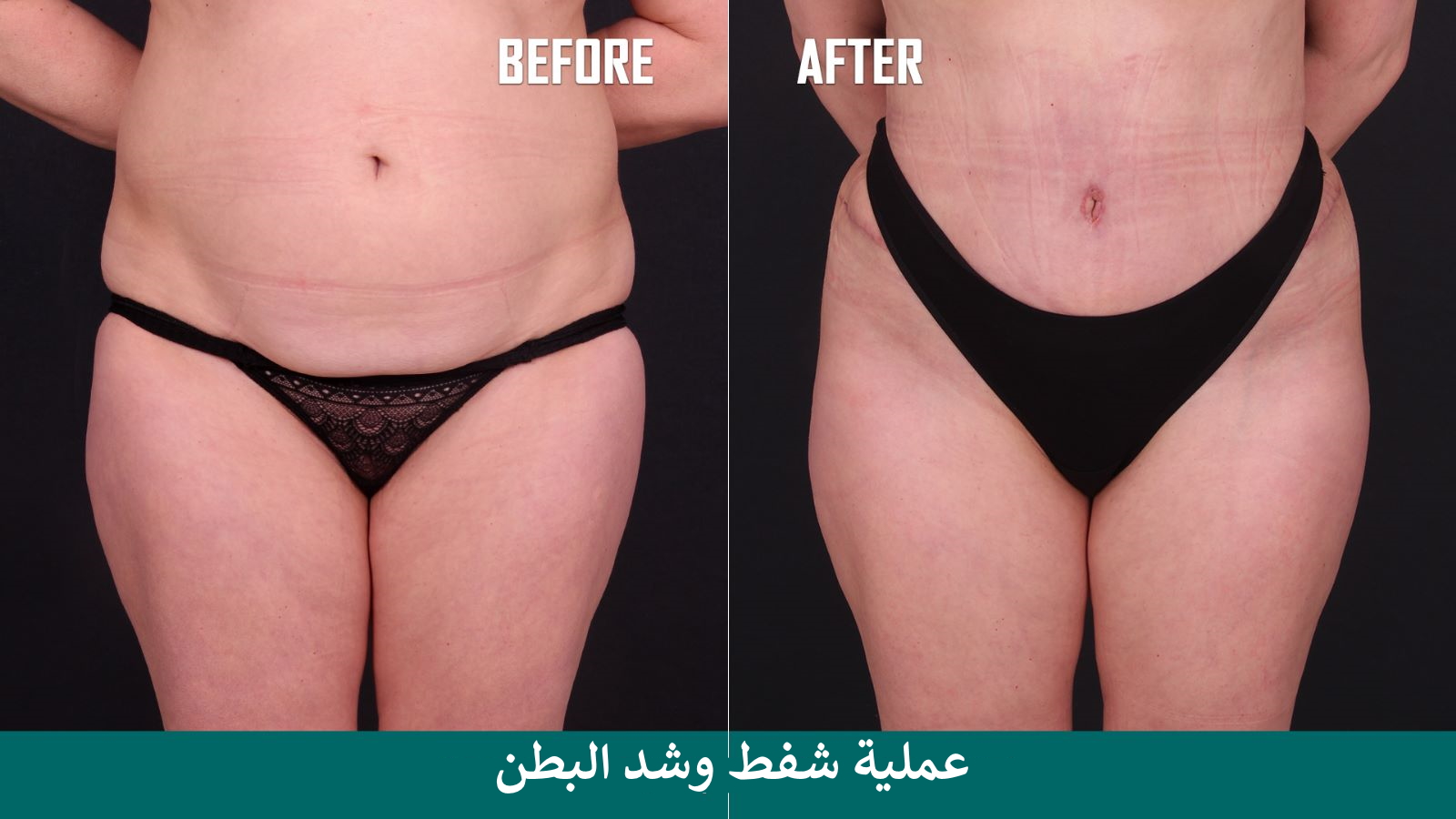 عملية شد البطن في تركيا