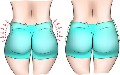 حقن الخفسات بالدهون الذاتية